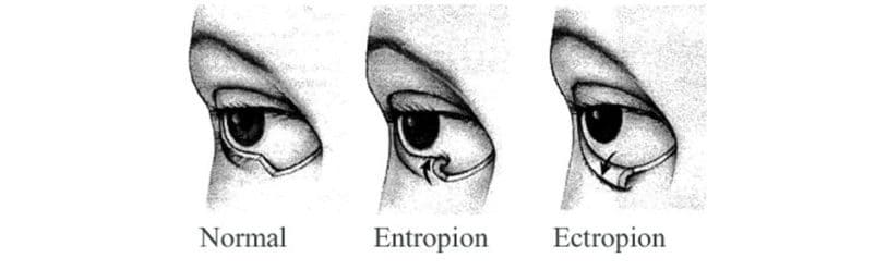 abnormality očných viečok