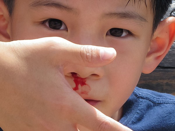krvácanie z nosa u detí
