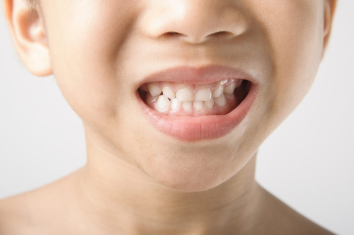 škvrny na detských zuboch