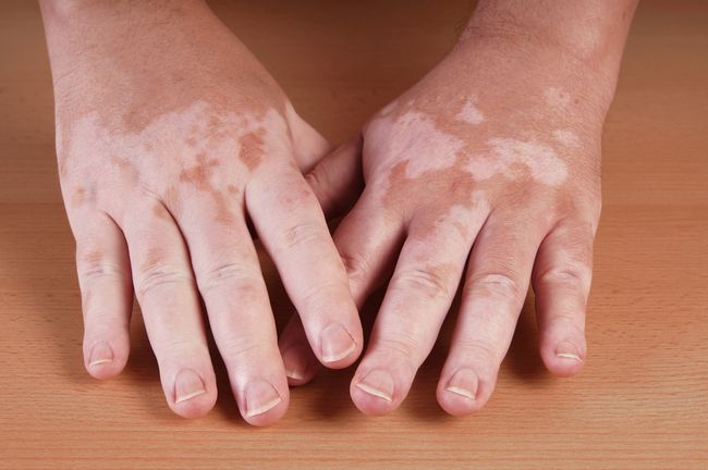 vitiligo sa môže liečiť