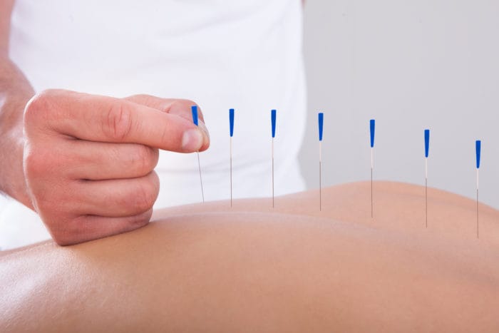 akupunktúra zmierňuje bolesť