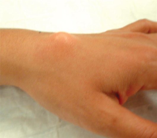 Kostra ganglií zápästia na zápästie (zdroj: Americká spoločnosť na chirurgickú operáciu ruky)