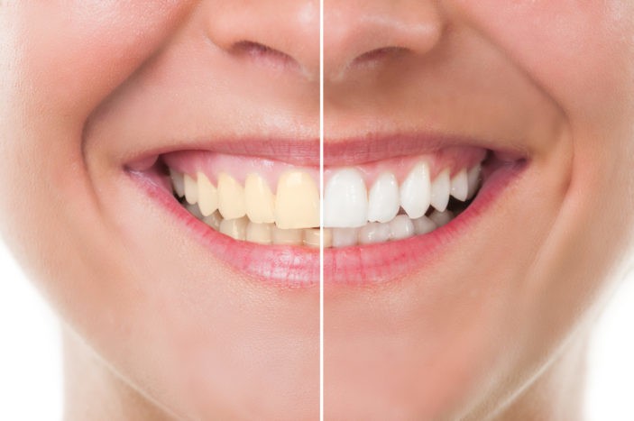 Nežiaduce účinky bielenia zubov s bielenie