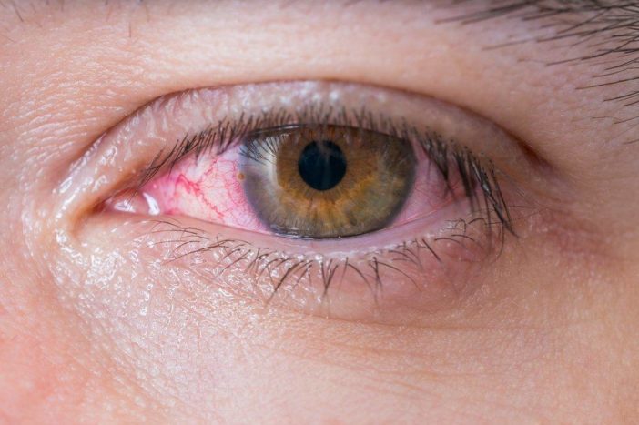 alergický zápal spojiviek červených očí