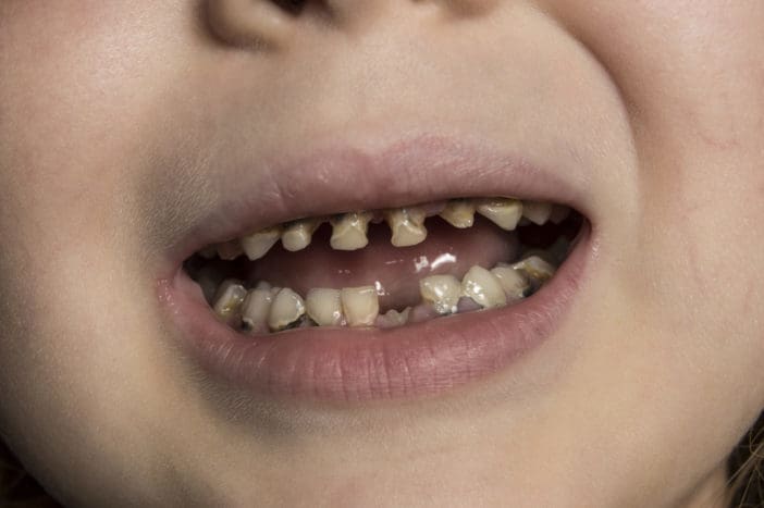 zubný kaz detskej fľaše na detský zub