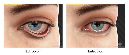 ektropión abnormalít očných viečok