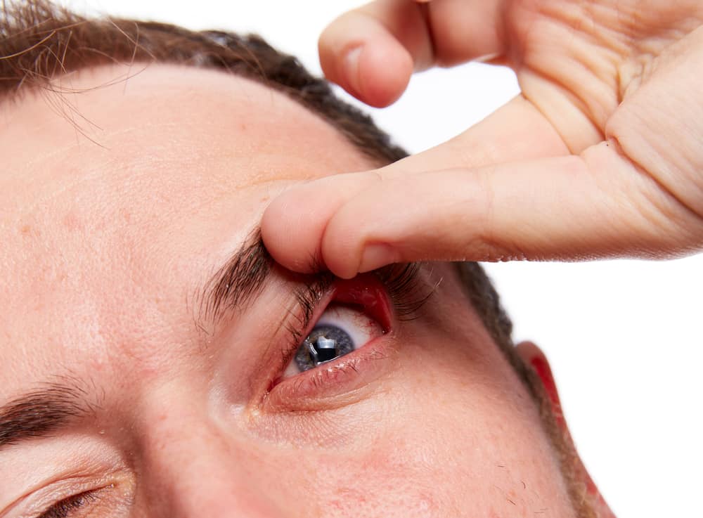 syndróm ovisnutého očného viečka