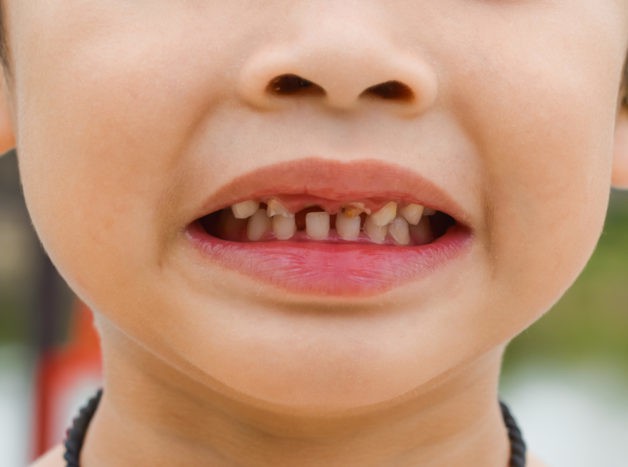 poškodenie zubov detí