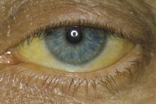 žlté oči